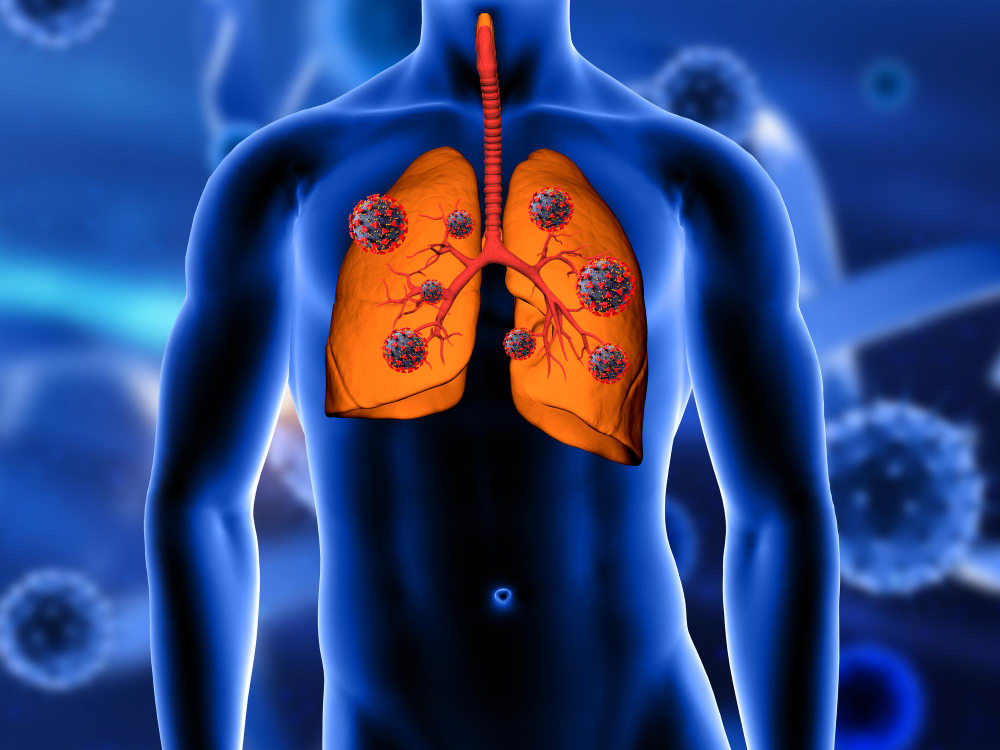 Chronic Obstructive Pulmonary Disease